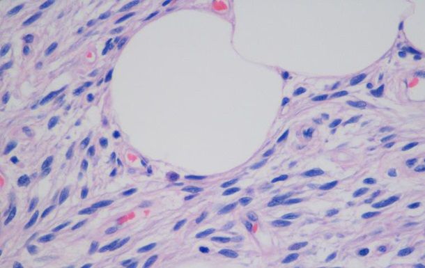 Создано нанолезвие для операций на клетках